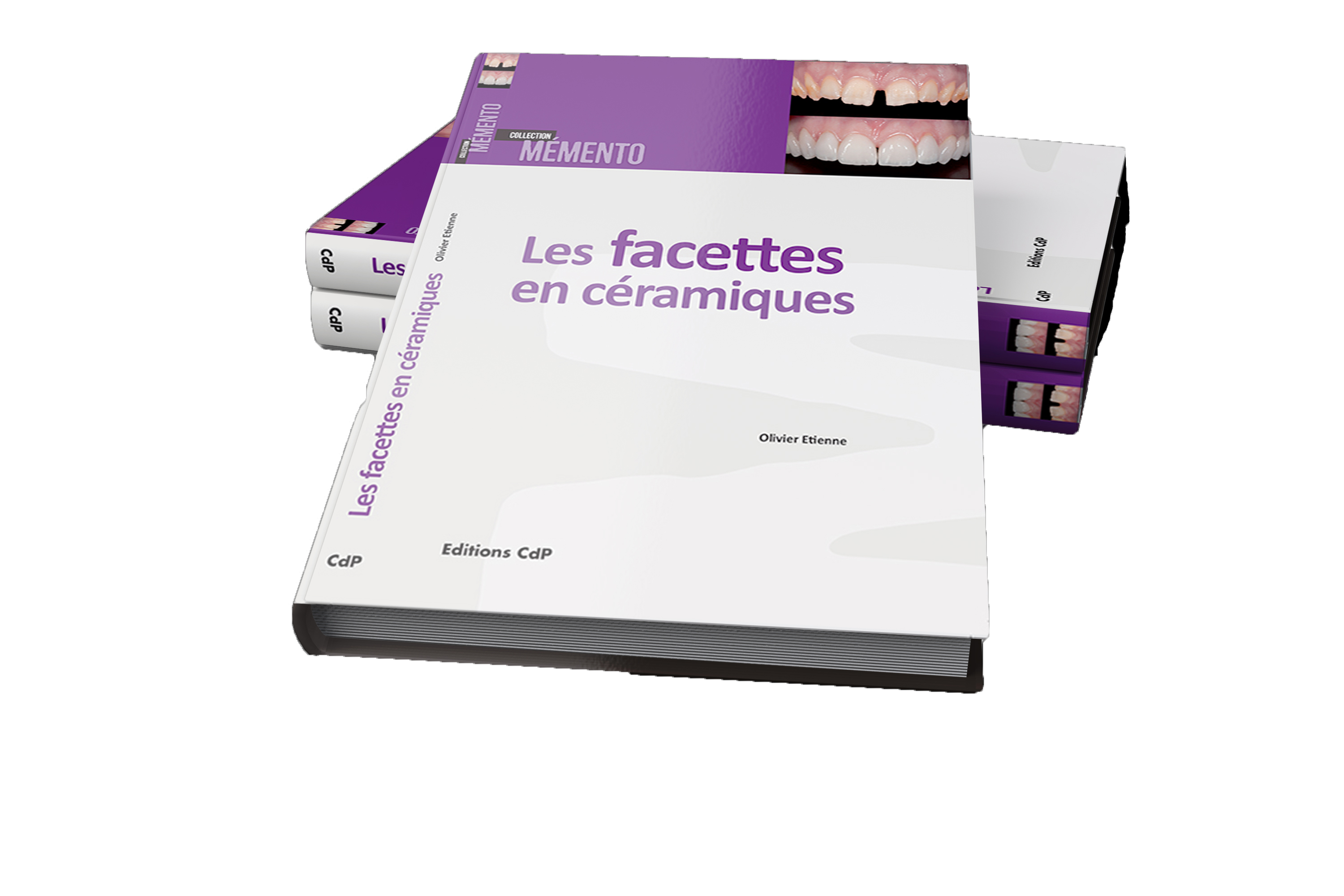 Facettes en céramique collée